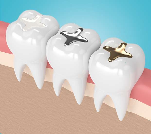 San Jose Composite Fillings