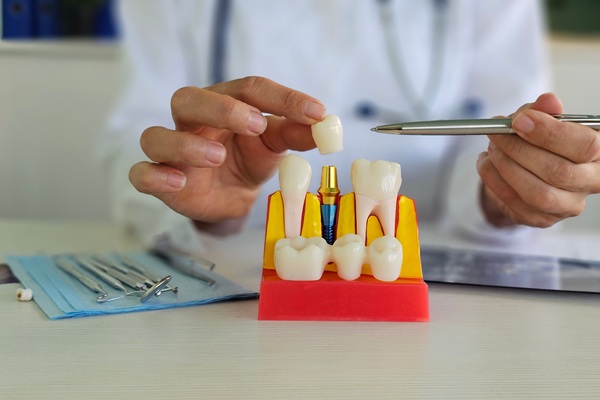 The Process Of Receiving Full Mouth Dental Implants